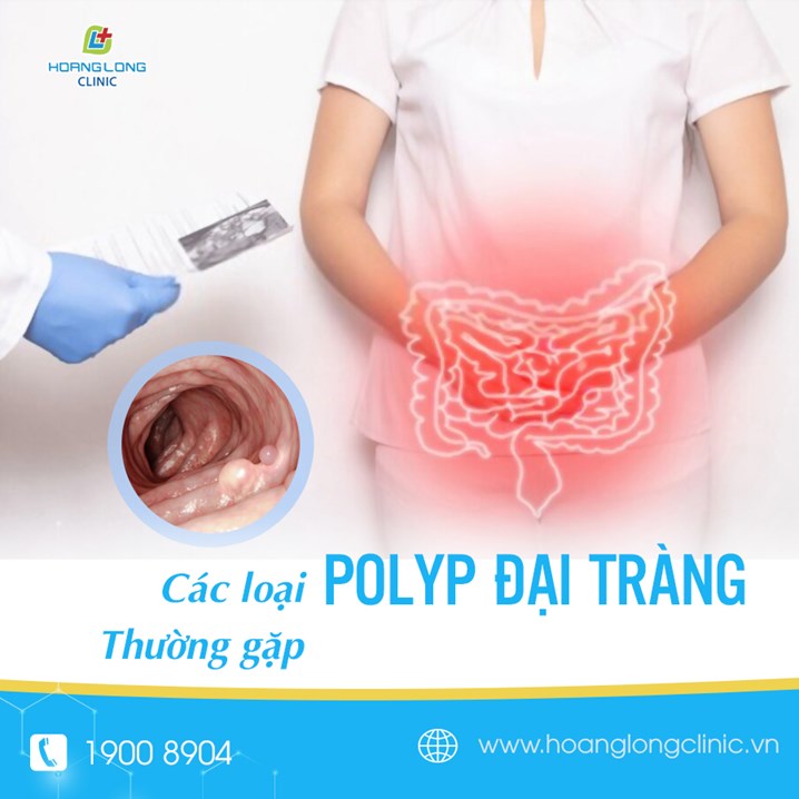 Các loại polyp đại tràng thường gặp