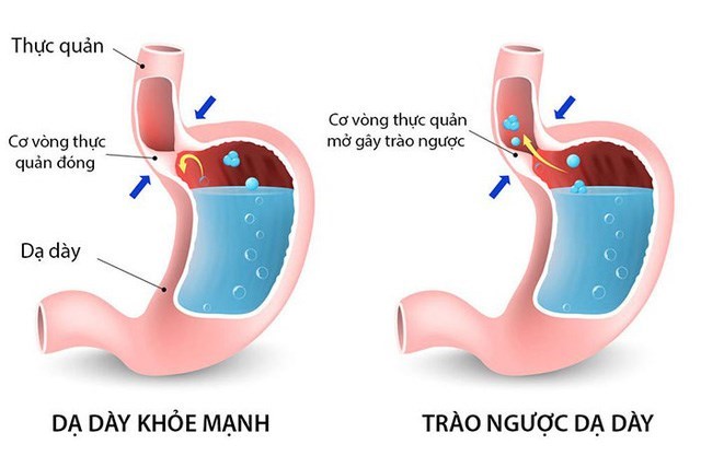 trào ngược dạ dày thực quản, kỹ thuật chẩn đoán trào ngược dạ dày