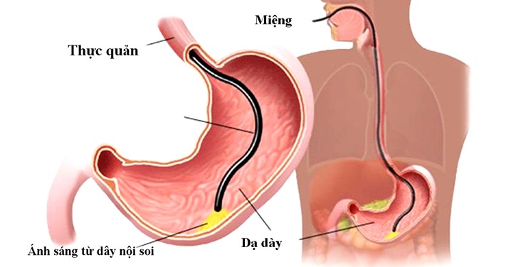 nội soi dạ dày, nội soi dạ dày nhiều lần có ảnh hưởng đến sức khoẻ không, nội soi dạ dày bao lâu một lần