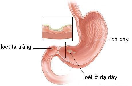 Viêm loét dạ dày, tá tràng là bệnh gì?