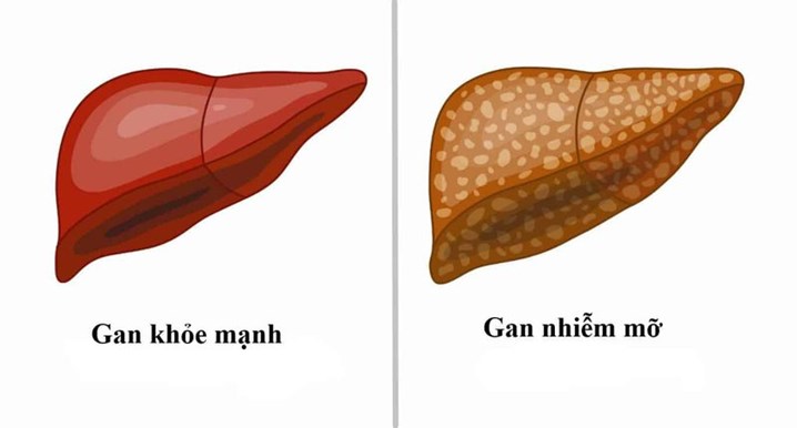 bệnh gan nhiễm mỡ, gan nhiễm mỡ có nguy hiểm không, xơ gan, ung thư gan