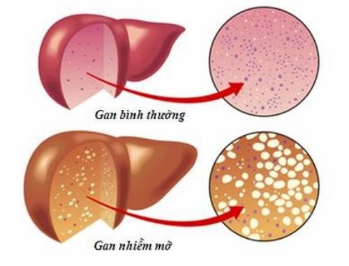 gan nhiễm mỡ, gan nhiễm mỡ do rượu, gan nhiễm mỡ tiến triển thành xơ gan