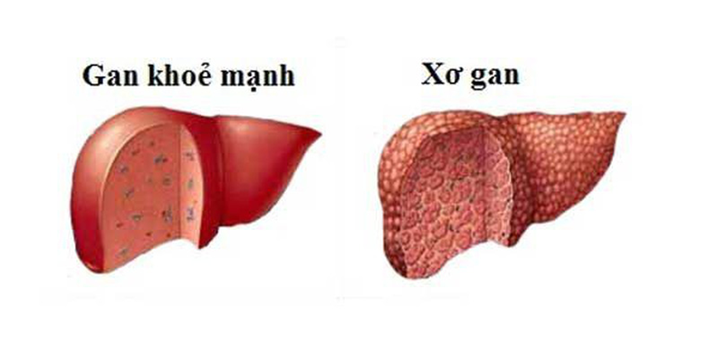 xơ gan là gì, nguyên nhân gây xơ gan