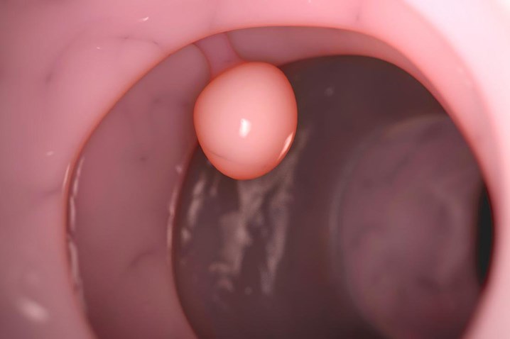 polyp dạ dày, polyp dạ dày có nguy hiểm không, cắt polyp dạ dày