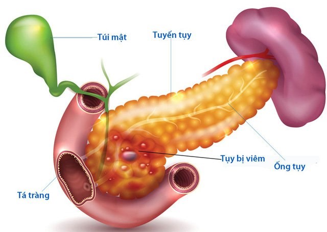 viêm tụy cấp, viêm tụy cấp ngày Tết, viêm tụy mạn, biến chứng của viêm tụy cấp