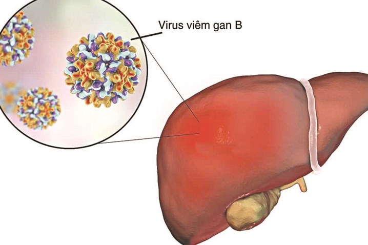 viêm gan B có gây ra ung thư gan không, viêm gan b là gì, tiêm phòng viêm gan b