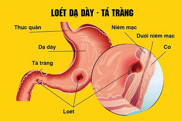 viêm loét dạ dày, tá tràng; nội soi dạ dày, tá tràng; vi khuẩn HP, nhiễm khuẩn HP