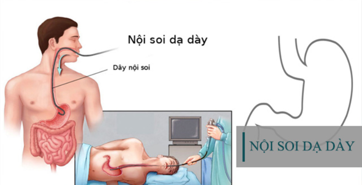 nội soi dạ dày, noi soi da day, kinh nghiệm đi nội soi dạ dày