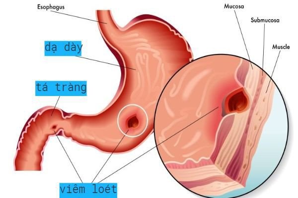 viêm loét dạ dày, viêm loét dạ dày là bệnh gì, nội soi dạ dày, viêm loét dạ dày nguyên nhân