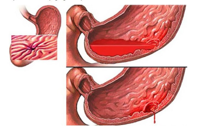 Nguyên nhân gây xuất huyết tiêu hóa