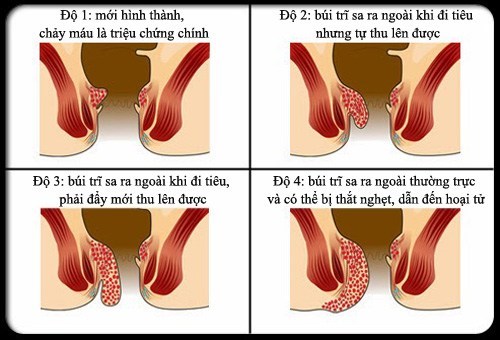 trĩ là bệnh gì, trĩ là gì, trĩ nội, trĩ ngoại