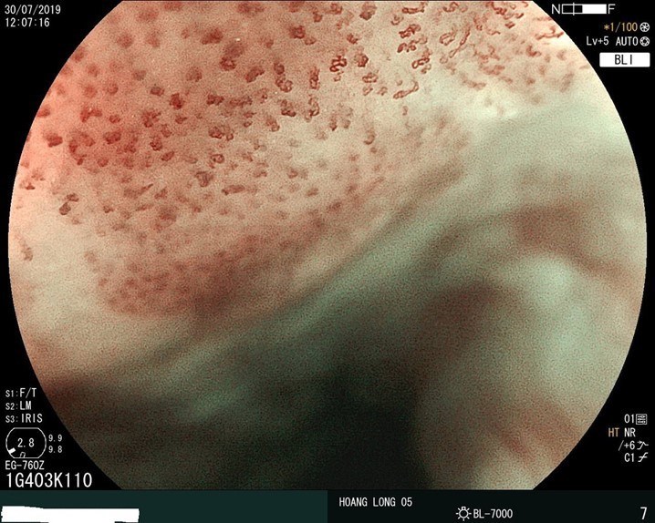 Photo - Early-stage esophageal cancer on endoscopic magnification