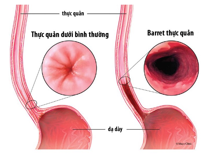 ung thư thực quản, ung thư