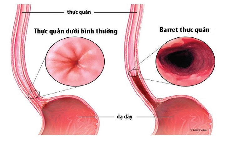 Vậy thế nào gọi là Barrett thực quản ?