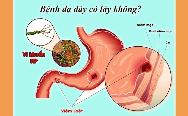 Viêm loét dạ dày, tá tràng có lây không?