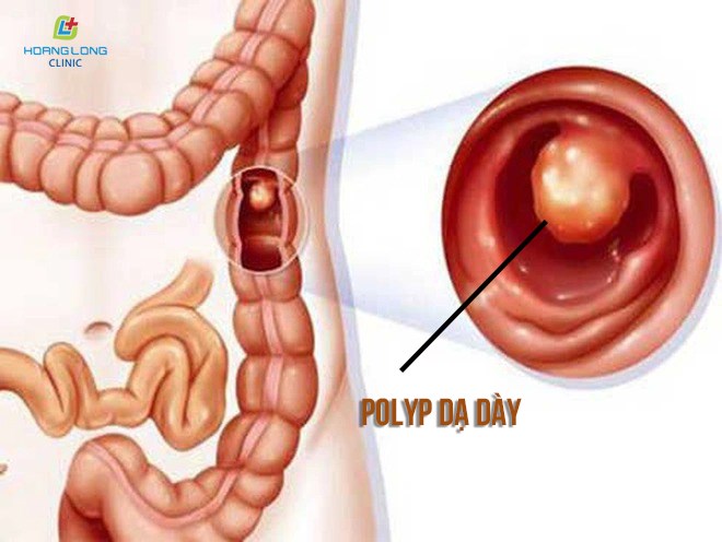 Polyp dạ dày