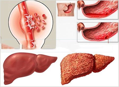 xơ gan, xơ gan F4, xơ gan F4 có chữa được không