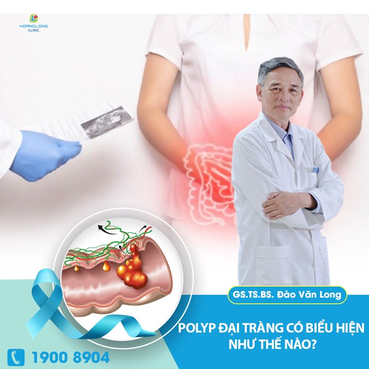 Polyp đại tràng có biểu hiện như thế nào?