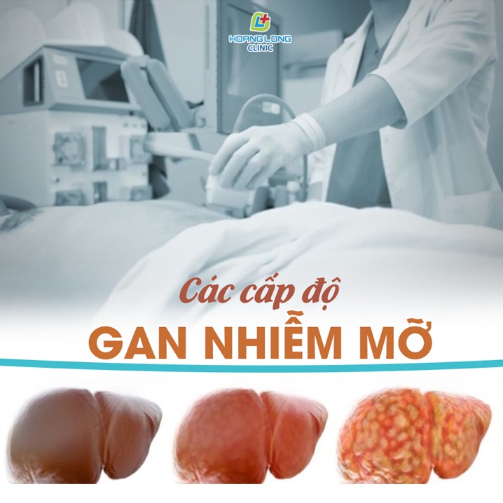 Các cấp độ của gan nhiễm mỡ