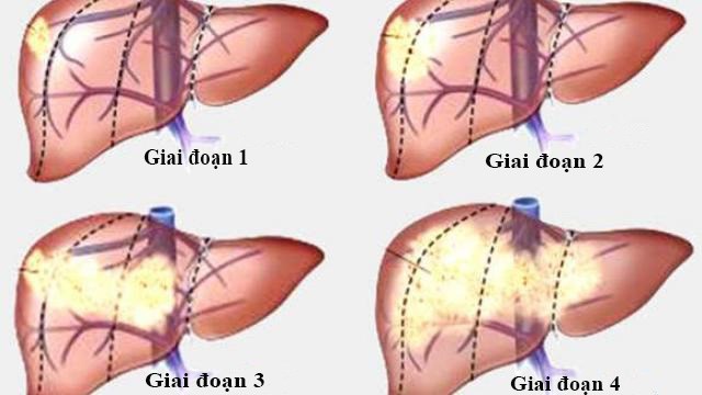 ung thư gan, các giai đoạn của ung thư gan