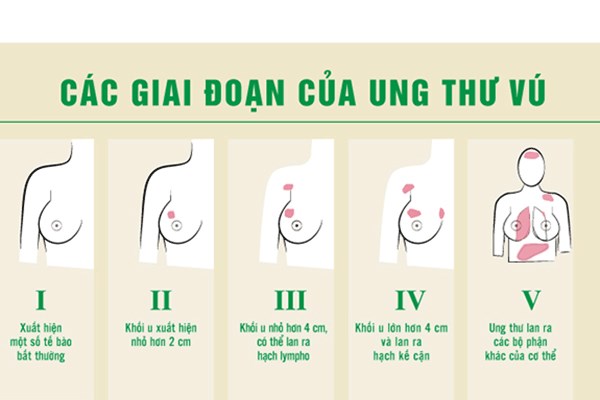 Các giai đoạn của ung thư vú