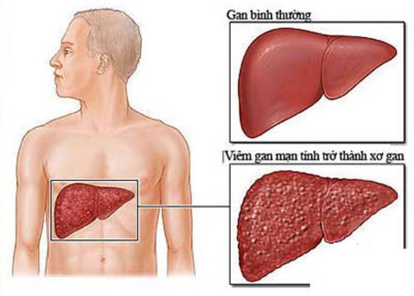 xơ gan là gì, nguyên nhân gây xơ gan