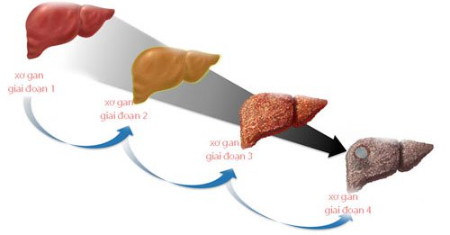 xơ gan sống bao lâu, xơ gan sống được bao lâu, xơ hóa gan, xơ gan giai đoạn cuối
