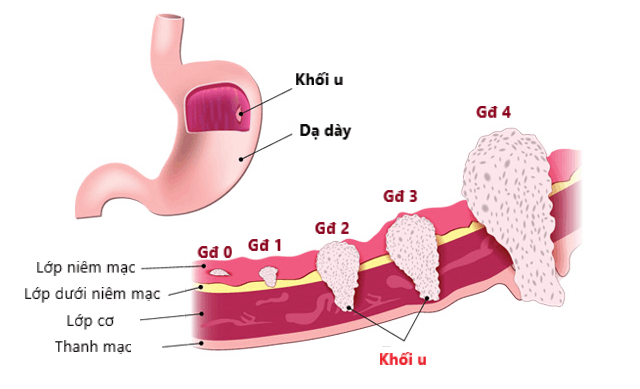 Ảnh minh họa: Các giai đoạn của ung thư dạ dày