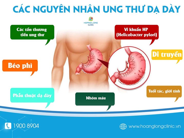 Ảnh minh họa: Các nguyên nhân ung gây ung thư dạ dày