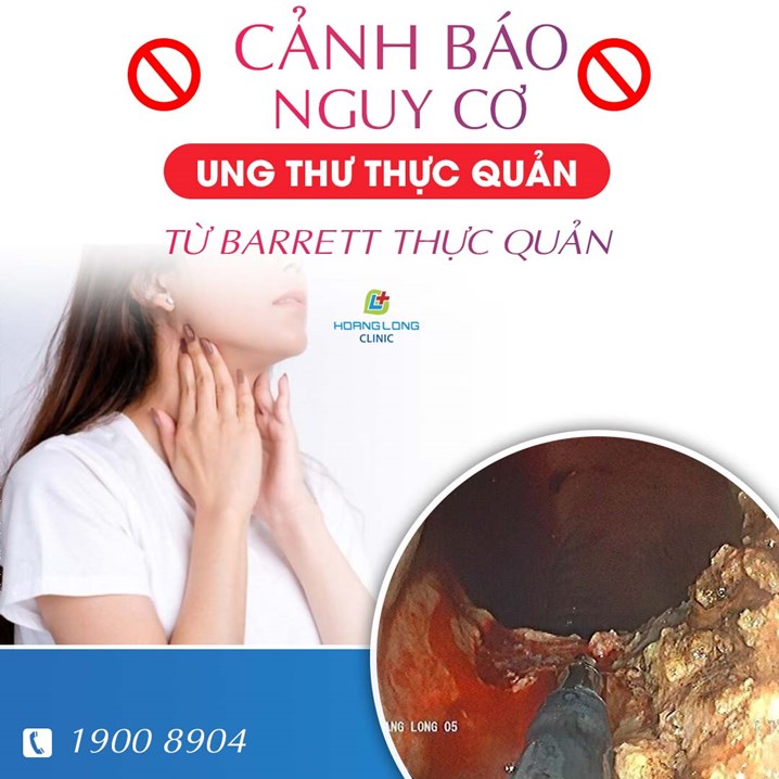 Nguy cơ chuyển biến thành ung thư từ barrett thực quản