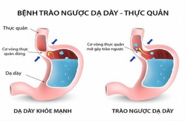 Trào ngược dạ dày thực quản (ảnh minh họa)