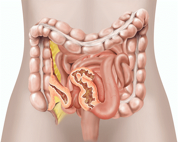 crohn, bệnh crohn