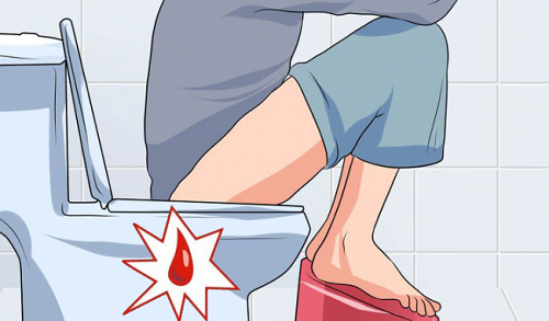 trĩ nội là  gì, giai đoạn của trĩ nội, trĩ nội độ 1, trĩ nội độ 2, trĩ nội độ 3, trĩ nội độ 4