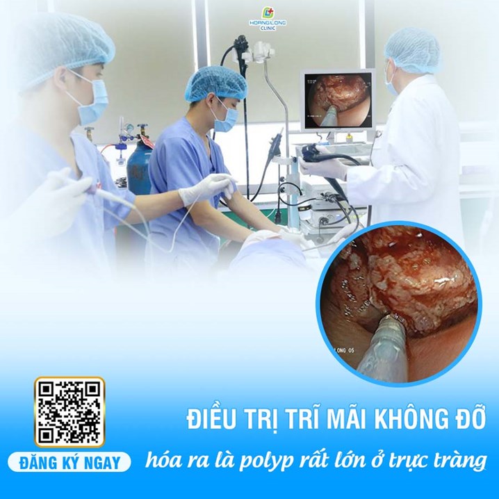 Điều trị trĩ mãi không đỡ hóa ra là polyp rất lớn ở trực tràng