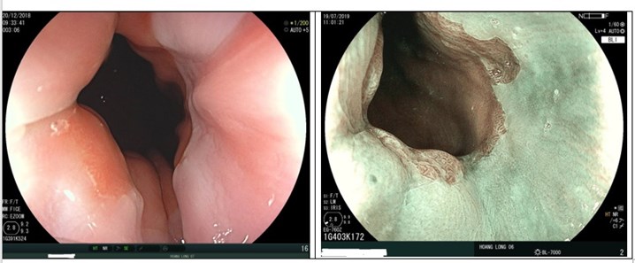 trào ngược dạ dày thực quản, viêm thực quản, điều trị trào ngược dạ dày thực quản