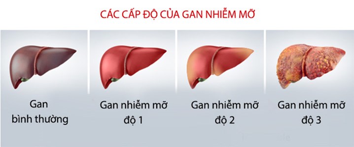 bệnh gan nhiễm mỡ, gan nhiễm mỡ có nguy hiểm không, xơ gan, ung thư gan
