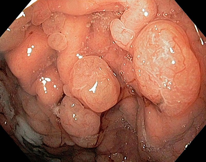 Polyp dạ dày có kích thước lớn có thể biến chuyển thành ung thư