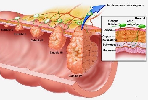 Các giai đoạn của ung thư thực quản