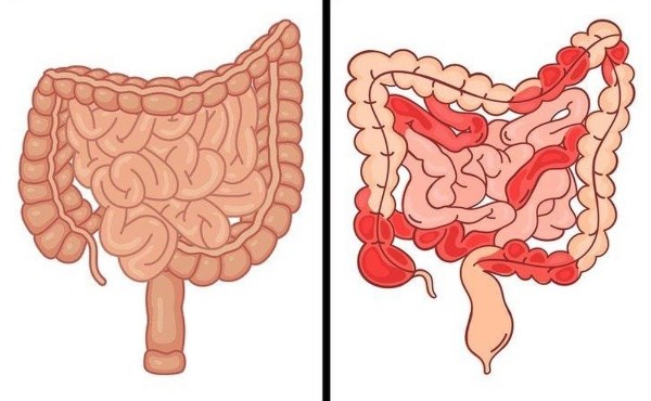 ruột non, nội soi ruột non, nội soi ruột non bằng bóng đôi, bệnh lý tiêu hoá, nội soi tiêu hoá