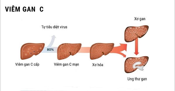 Ảnh minh họa: Khám viêm gan C ở đâu tốt