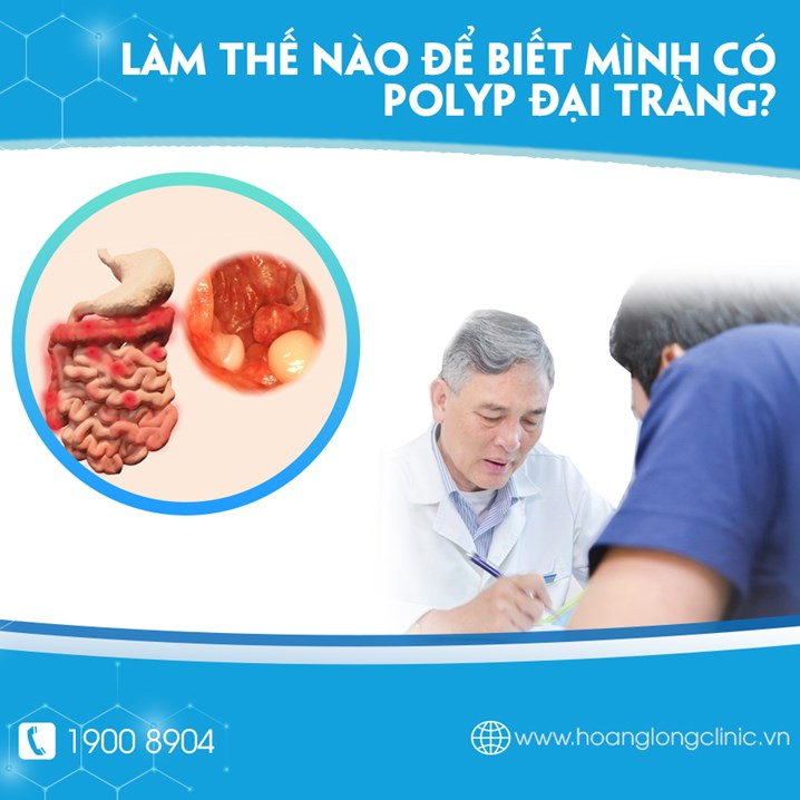 Làm thế nào để biết mình có bị polyp đại tràng