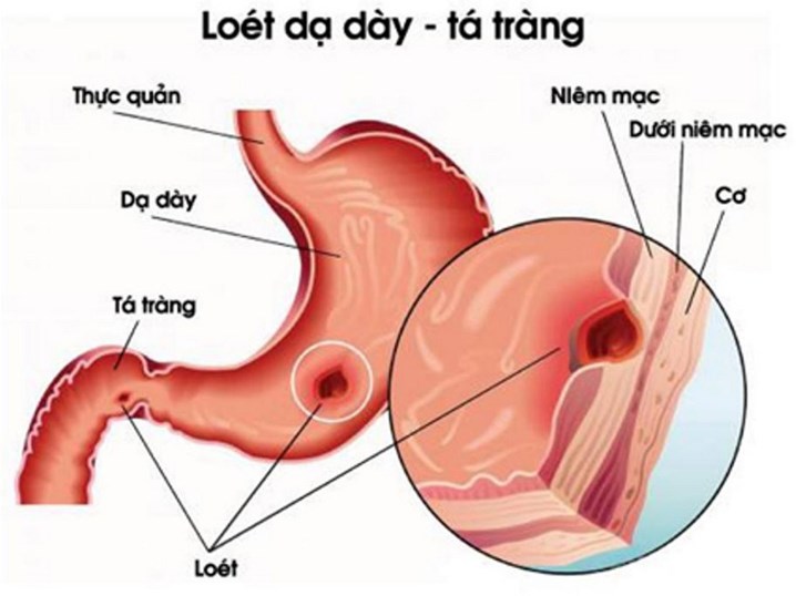 viêm loét dạ dày nên ăn gì, viêm loét dạ dày không nên ăn gì