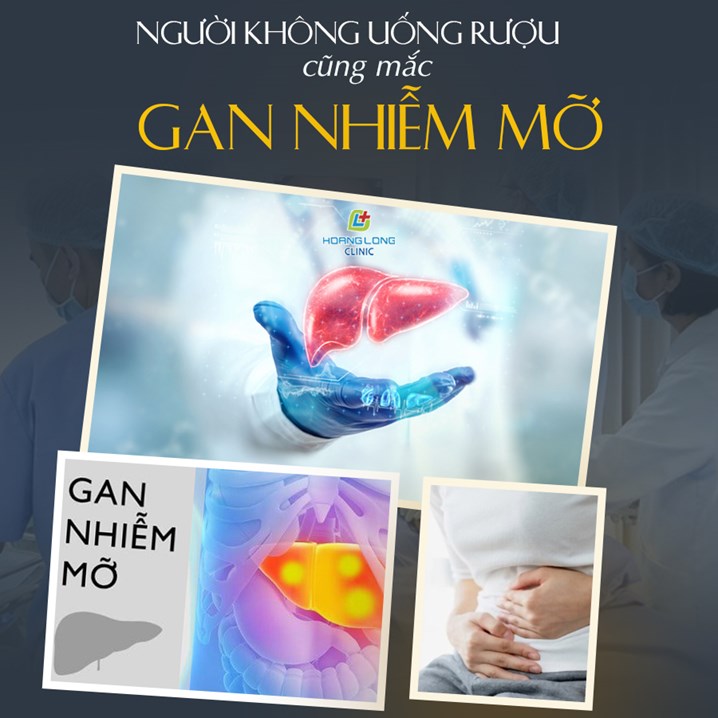 Người không uống rượu cũng mắc gan nhiễm mỡ