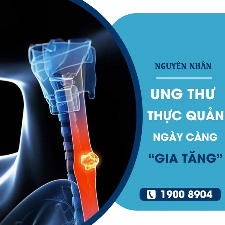 nguyên nhân bênh ung thư thực quản ngày càng gia tăng?