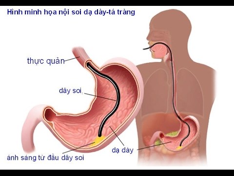 nội soi dạ dày, nội soi dạ dày là gì, nội soi dạ dày là bị gì