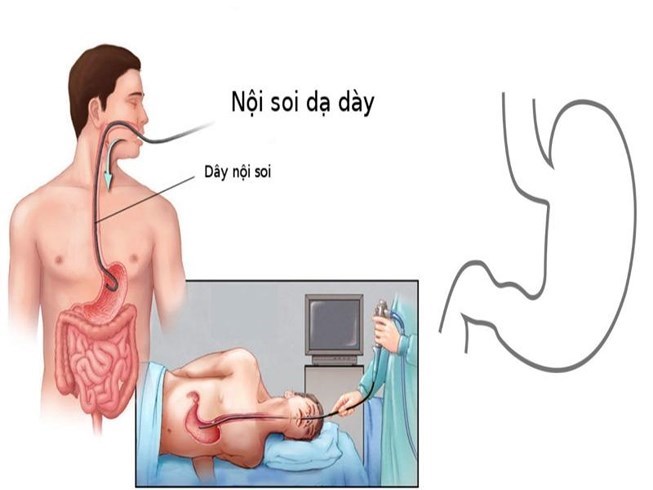 nội soi dạ dày xong bị đau bụng, nội soi dạ dày xong bị đau họng, nội soi dạ dày, biến chứng sau nội soi dạ dày