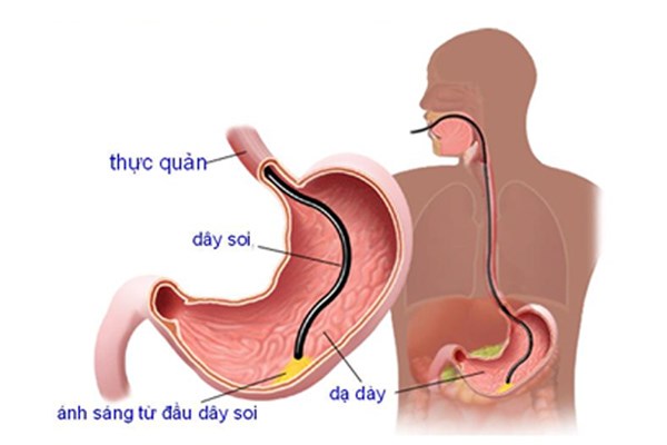 nội soi dạ dày, nội soi dạ dày làm gì, nội soi dạ dày ở đâu tốt nhất