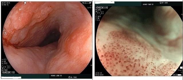  Early stage Esophagus Cancer detected by endoscopy with ordinary white light (left) and with magnifying and virtual staining technique (right) in Hoang Long Clinic.