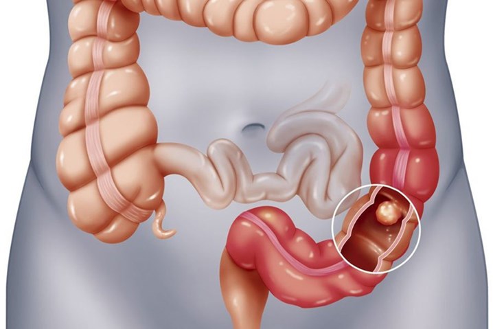 polyp đại tràng, polyp đại tràng có nguy hiểm không, cắt polyp đại tràng