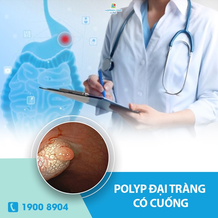 Polyp đại tràng có cuống